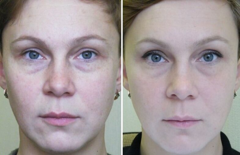 Photos before and after laser rejuvenation